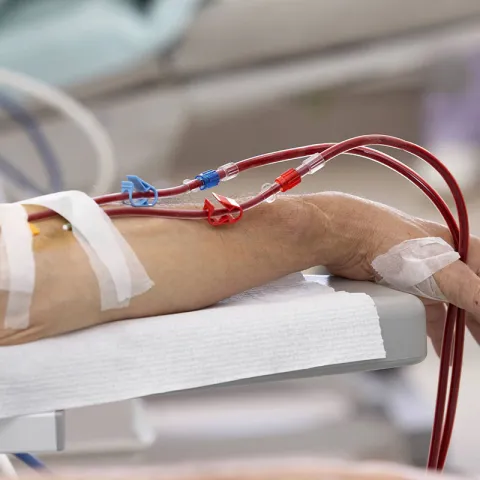 Arm an der Dialyse